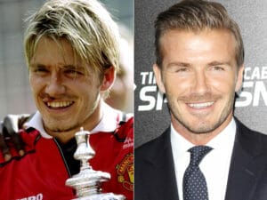 David Beckham Veneers Transformation