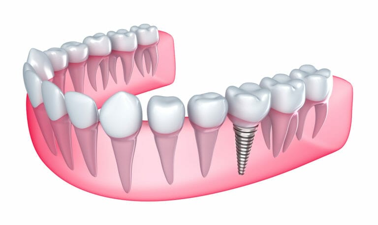 Here’s Everything You Need To Know About Dental Implants